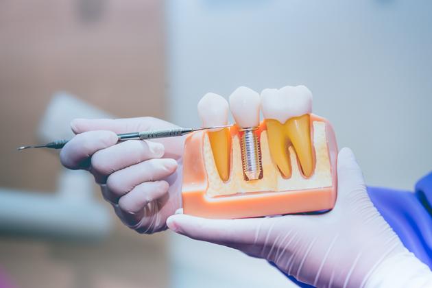 dental implants widnes