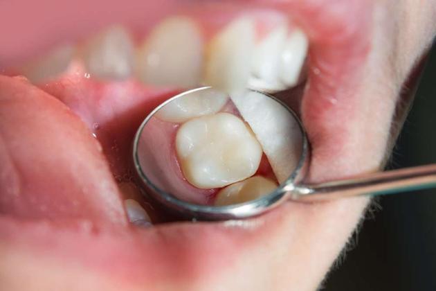 White Fillings Widnes | SAM Dentistry